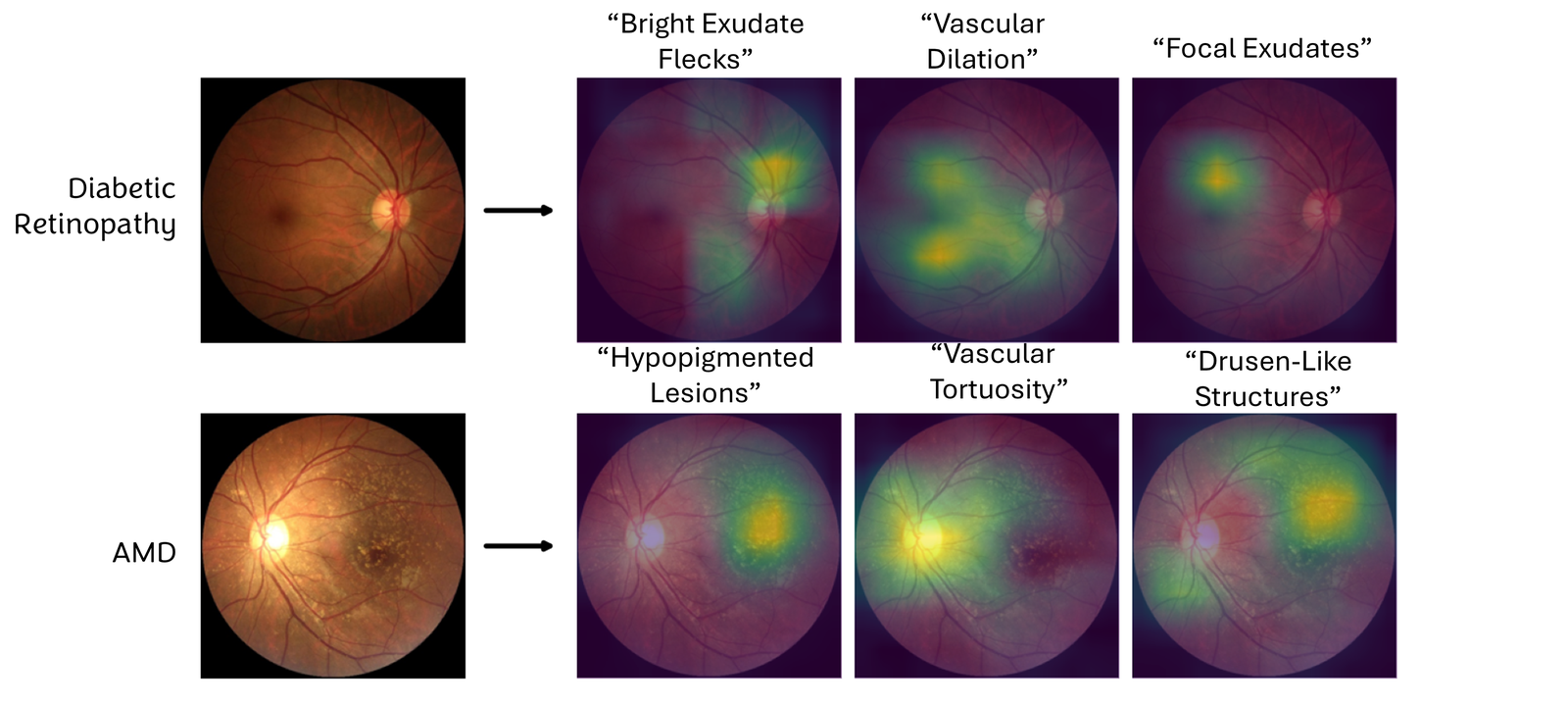 Fundus images for diabetic retinopathy and age-related macular degeneration with heatmaps labelled bright exudate flecks, vascular dilation, focal exudates, hypopigmented lesions, vascular tortuosity, drusen-like structures.